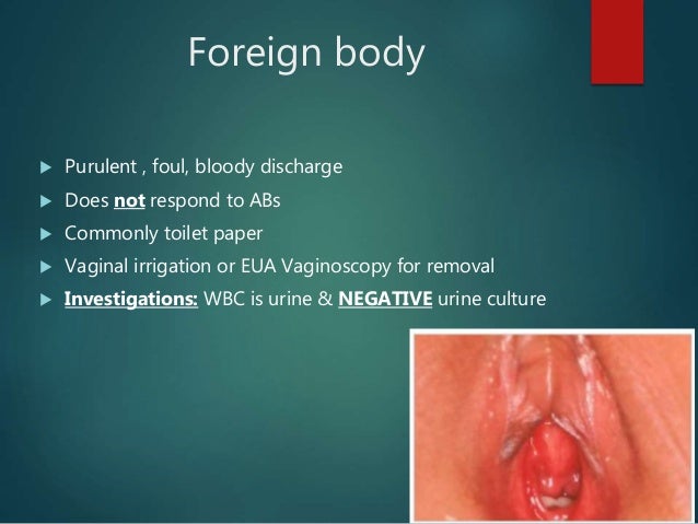 vaginal irrigation bleeding Transgender sex education